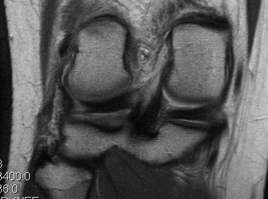 Knee LCL Midsubstance Tear PLC injury